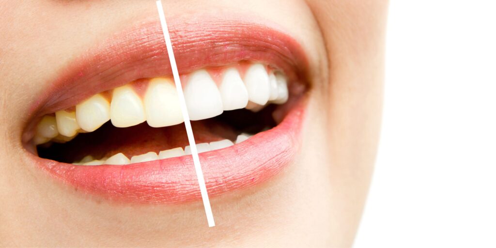 smalto denti rovinato trattamento per risolvere problema dentista milano