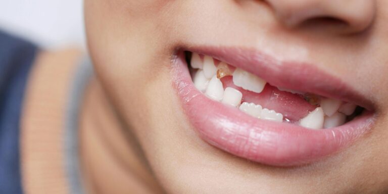 denti da latte che cadono quanti denti bambini