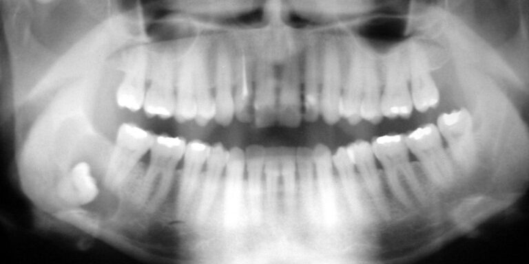 dente del giudizio incluso diagnosi trattamento sintomi quando toglierli perche importante toglierli clinica dentistica