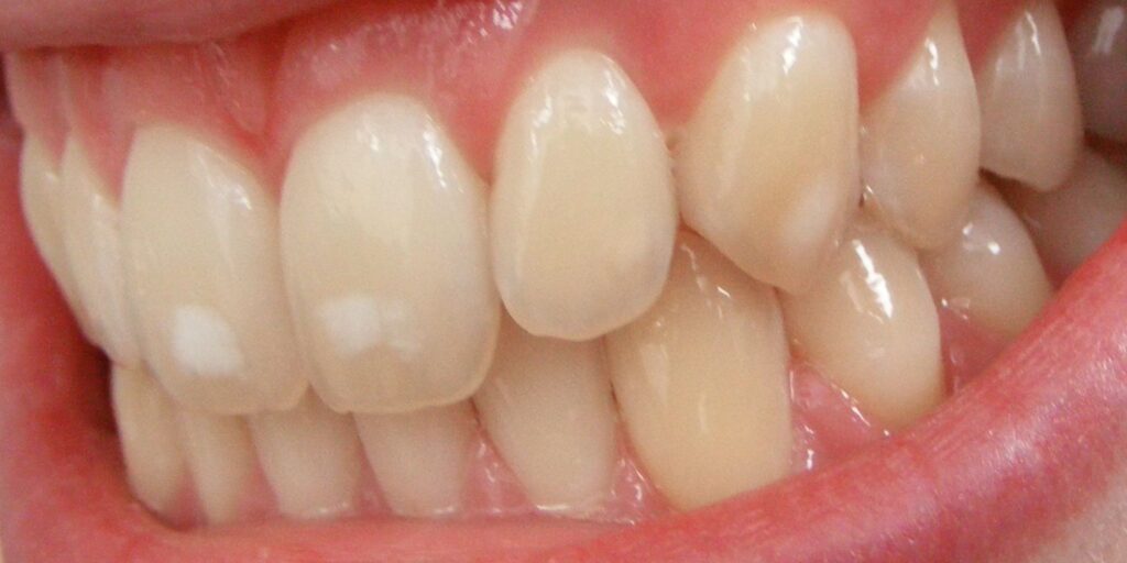 flourosi dentali cosa fare macchie sui denti dentista milano sintomi cause diagnosi come risolvere